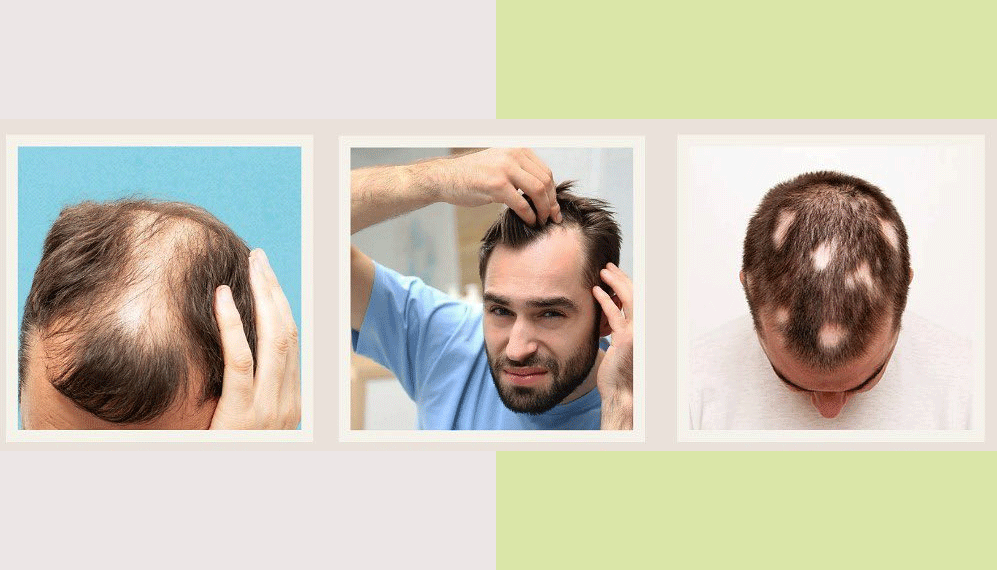 What are the various Abnormal hair loss Signs?